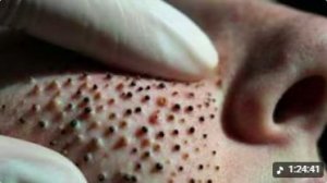 ЧИСТКА ЛИЦА КРУПНЫМ ПЛАНОМ — ЧЁРНЫЕ ТОЧКИ УХОДЯТ ОДНА ЗА ДРУГОЙ