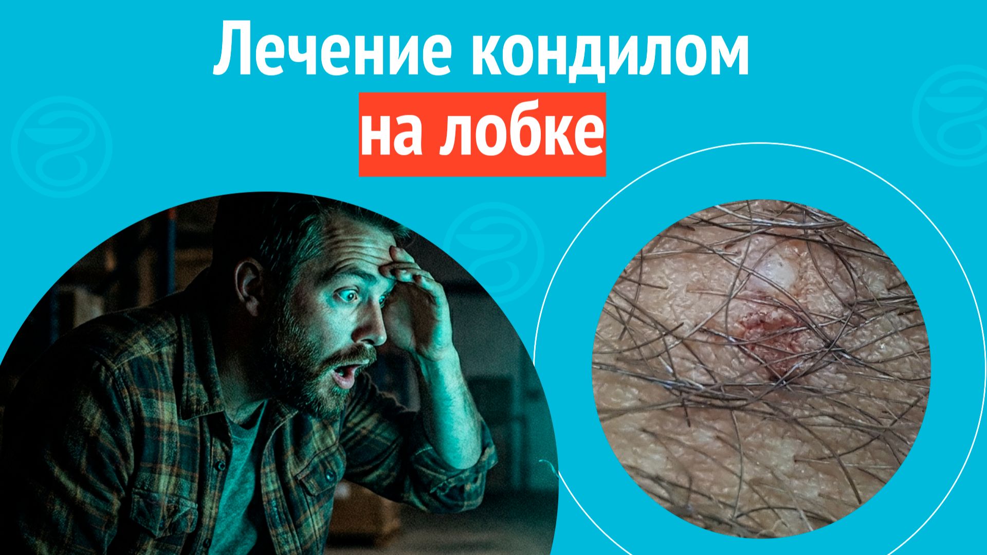 💊 Лечение кондилом на лобке. Клинический случай №1679 смотреть онлайн