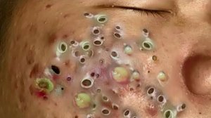 ДАВИМ ПРЫЩИ И ЧЕРНЫЕ ТОЧКИ КРУПНО