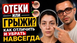 Как убрать мешки под глазами НАВСЕГДА? Отеки или грыжи? Как отличить и что реально поможет
