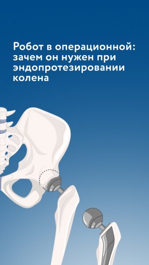 Робот в операционной: зачем он нужен при эндопротезировании колена