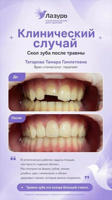 Клинический случай. Скол зуба после травмы