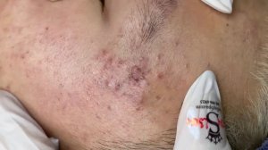 273 • Acne collection • АСМР • Relax Spa