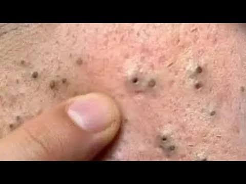 sac be spa: чистка лица от черных точек для пожилых мужчин | новая процедура смотреть онлайн