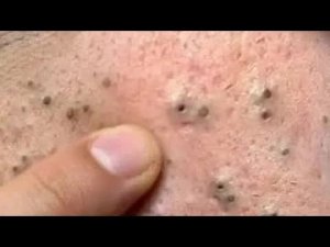 sac be spa: чистка лица от черных точек для пожилых мужчин | новая процедура