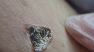 Криодеструкция кератомы крупным планом