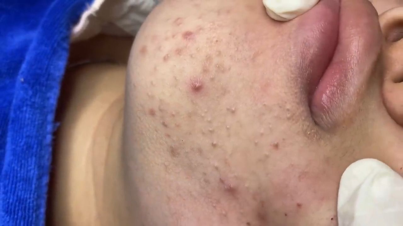 269 • Acne collection • АСМР • Relax Spa смотреть онлайн