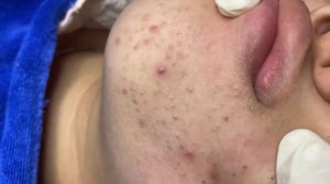 269 • Acne collection • АСМР • Relax Spa