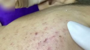 Loan Nguyen Acne Treatment 23ss