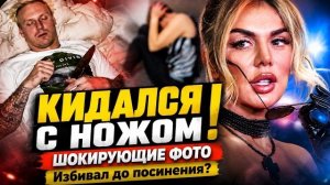 Избивал до посинения и кидался с ножом: Анна Седокова сливает жуткие фото Яниса Тиммы