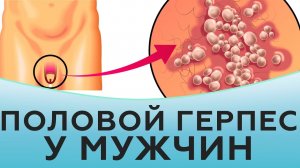 Как выглядит половой герпес у мужчин