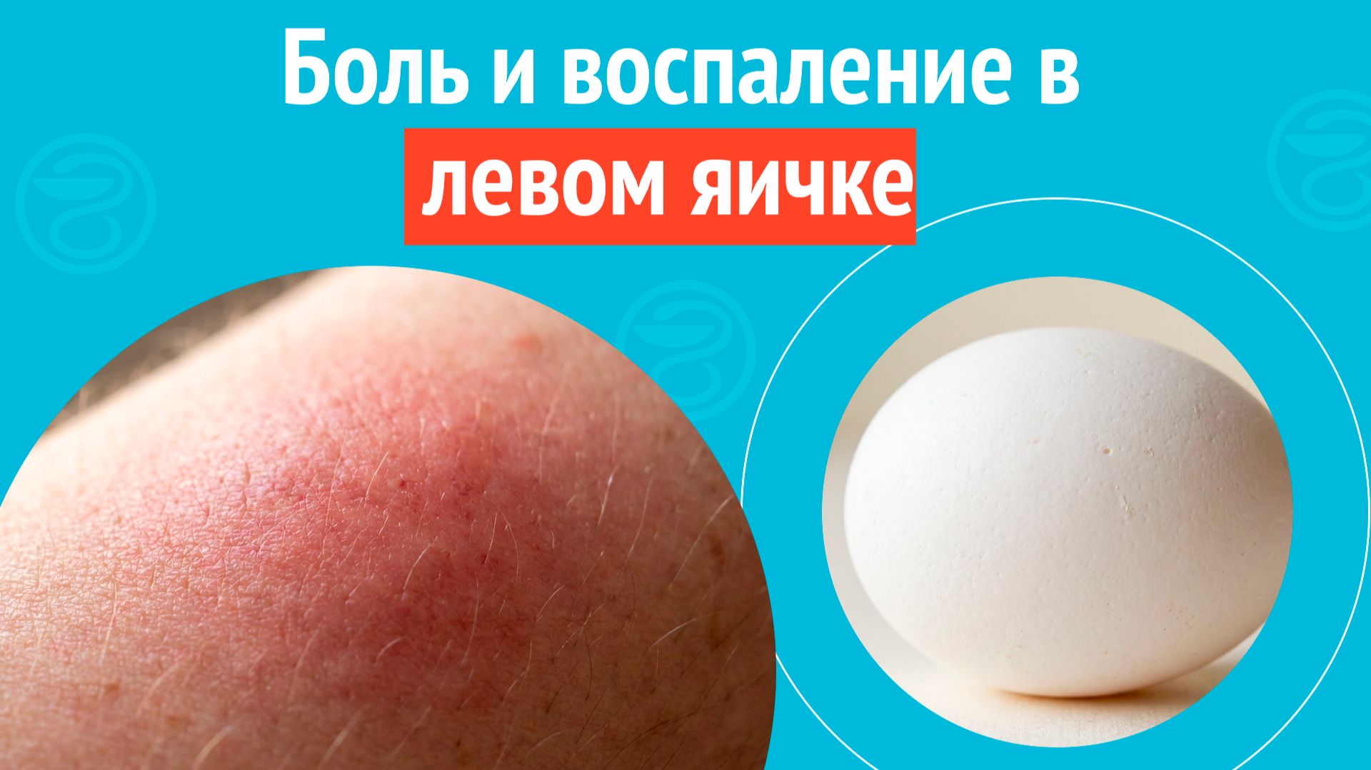 😠 Боль и воспаление в левом яичке. Клинический случай №1678 смотреть онлайн