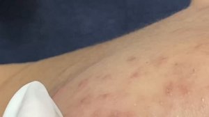 Удаление глубоких комедонов — достаем старые стержни