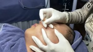 Удаление открытых комедонов — черные точки