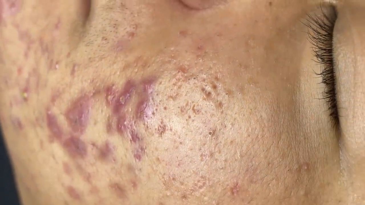 268 • Acne collection • АСМР • Relax Spa смотреть онлайн