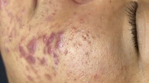 268 • Acne collection • АСМР • Relax Spa
