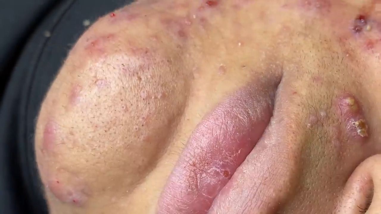 270 • Acne collection • АСМР • Relax Spa смотреть онлайн
