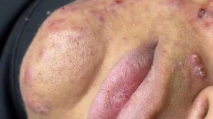 270 • Acne collection • АСМР • Relax Spa