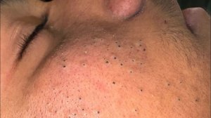 Уход за кожей | Корейская рутина для глубокого очищения пор и ухода за прыщами