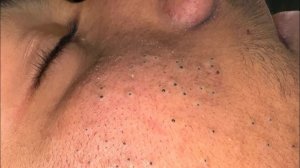 Глубокое очищение пор и удаление черных точек | Удовлетворяющее лечение прыщей