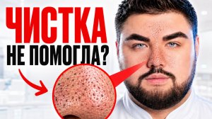 ЧЁРНЫЕ ТОЧКИ на лице: как убрать и почему они возвращаются после чистки | MESOMATRIX