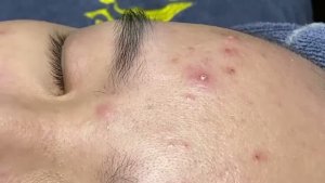 Удаление закрытых комедонов — белые угри под кожей