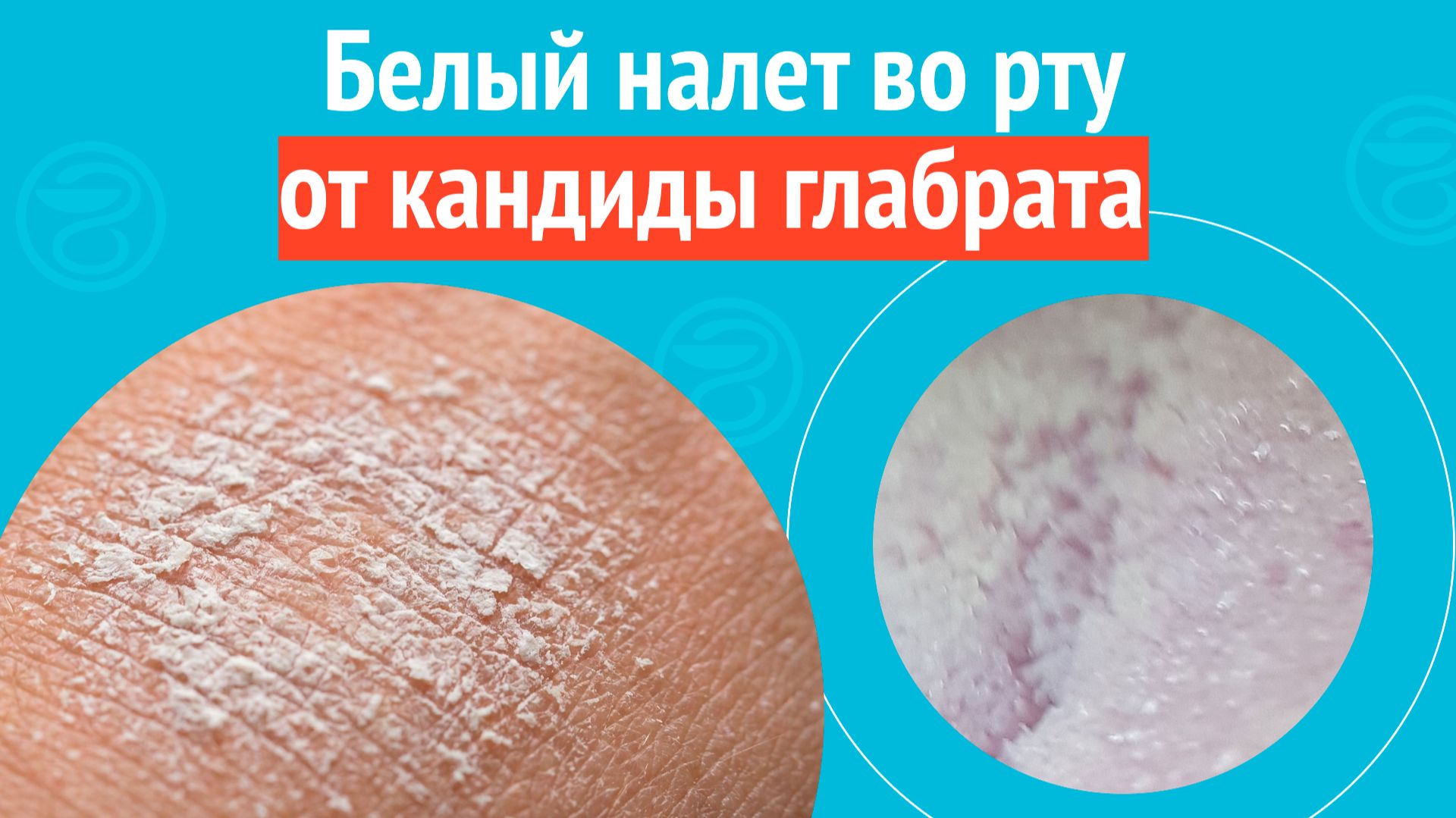 👅 Белый налет во рту от кандиды глабрата. Клинический случай №1677 смотреть онлайн