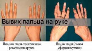 Вывих пальца на руке