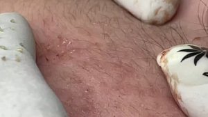 Профессионально чистим кожу от прыщей