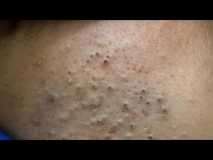Глубокое очищение лица | Удаление черных точек и уход за кожей