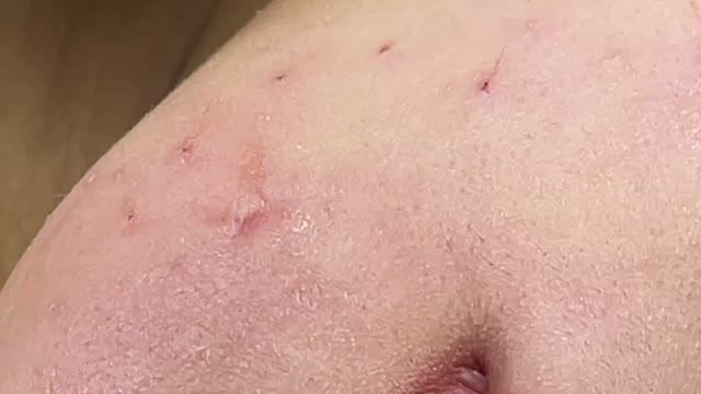 Выдавливаем прыщи и удаленяем сальные пробки. смотреть онлайн