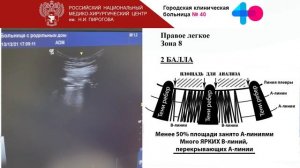 УЗИ легких кейс2 Щепарев И.С.