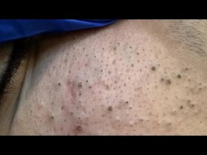 Полный гид по удалению черных точек — техники и советы | Уход за кожей