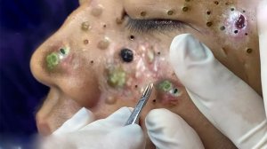 Экстремальное удаление черных точек: расслабляющее видео