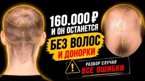 Этому парню нельзя делать пересадку волос