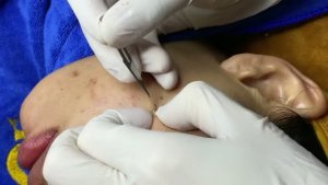 Чистка лица от прыщей, черных точек и комедонов