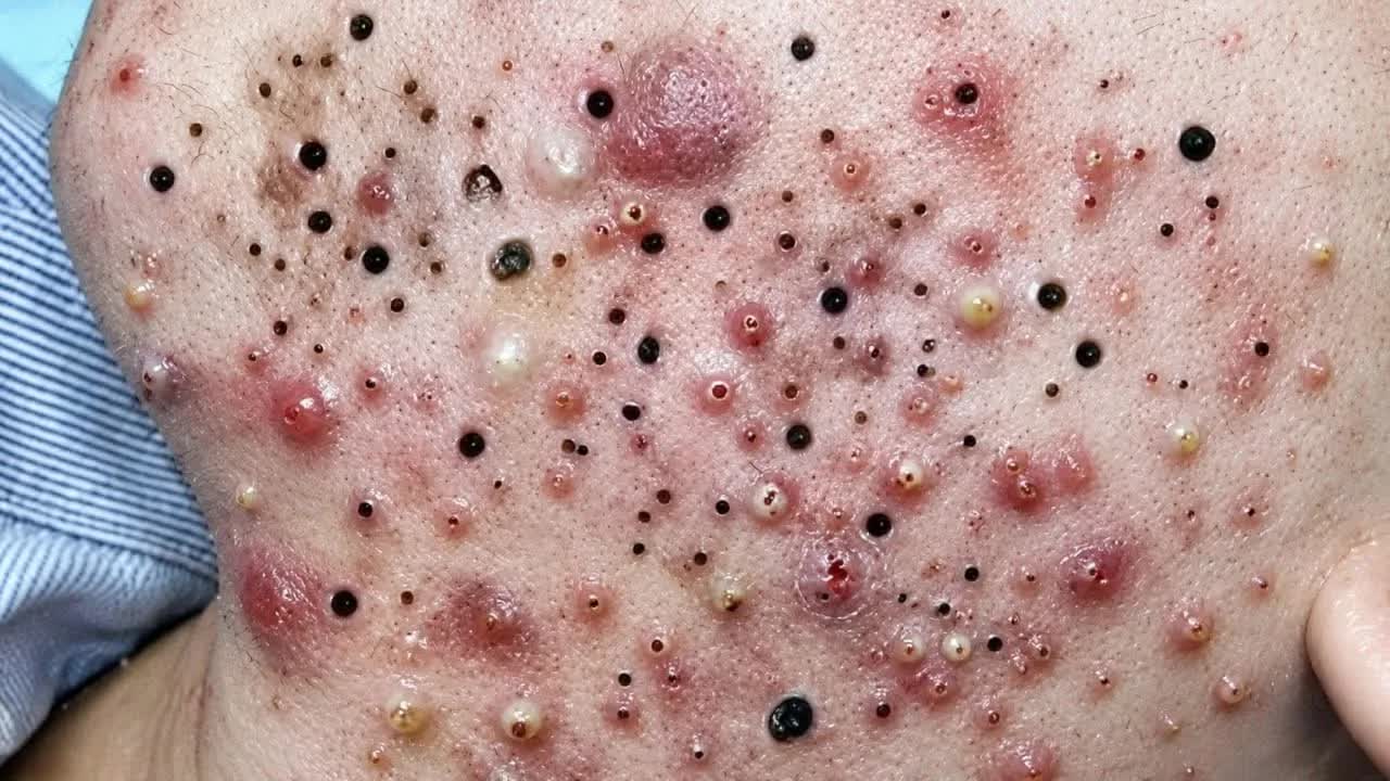 Удаление грязи из-под кожи освежает смотреть онлайн