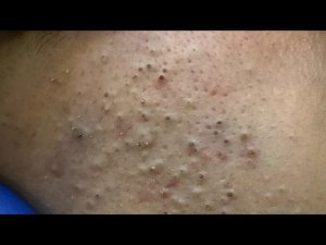 Ультимативное средство от прыщей! Глубокое очищение салициловой кислотой! УХОД ЗА КОЖЕЙ