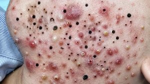 Удаление грязи из-под кожи освежает