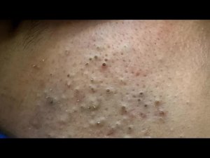 Глубокое очищение пор от черных точек | Корейский уход за кожей