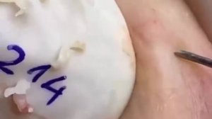 Экстремальное удаление черных точек 🧖♂️
