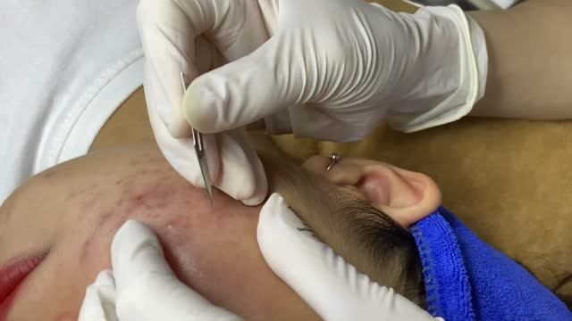 Удаление множественных комедонов на лице смотреть онлайн
