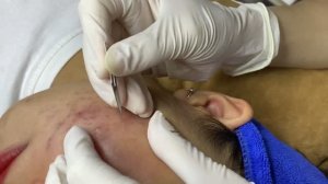 Удаление множественных комедонов на лице