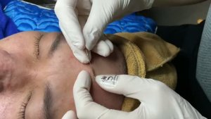 Удаление черных точек и закрытых комедонов