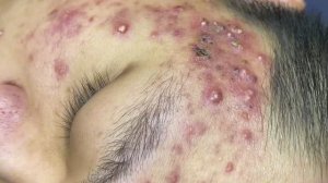 Релакс и уход Профессиональное лечение угревой сыпи