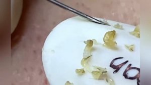 Выдавливание прыщей, угрей, черных точек и камедонов #600