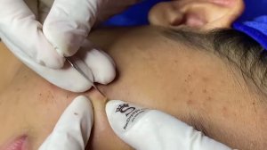 Черные точки у молодой девушки — механическая чистка в салоне