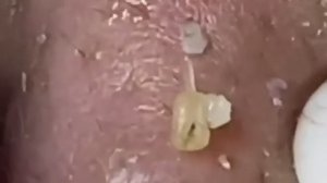 Экстремальное удаление черных точек: расслабляющее видео