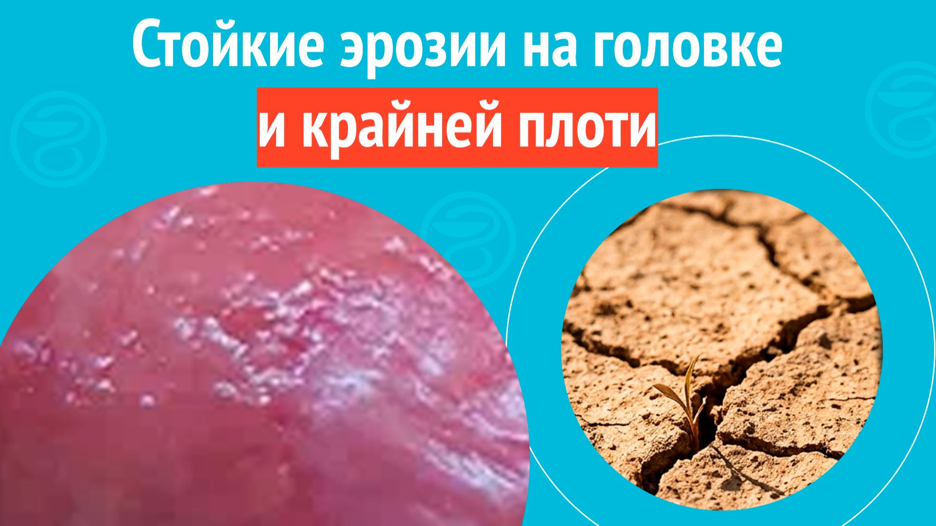 😦 Стойкие эрозии на головке и крайней плоти. Клинический случай № 1813
