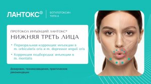 Протокол инъекций ЛАНТОКС®. Нижняя треть лица